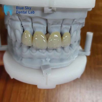 কেনা সিরকোনিয়া মাল্টিলেয়ার মুকুট online manufacture
