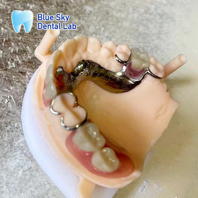 মেটাল ফ্রেমের সাথে হালকা এক্রাইলিক রজন আংশিক দাঁত বাস্তবসম্মত দেখায় দাঁত
